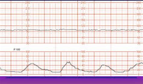fetal monitor strips practice|fetal monitor strip test Flashcards .